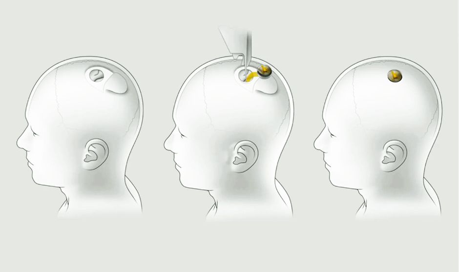 Implanty od Neuralink